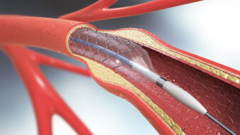 stent implantation