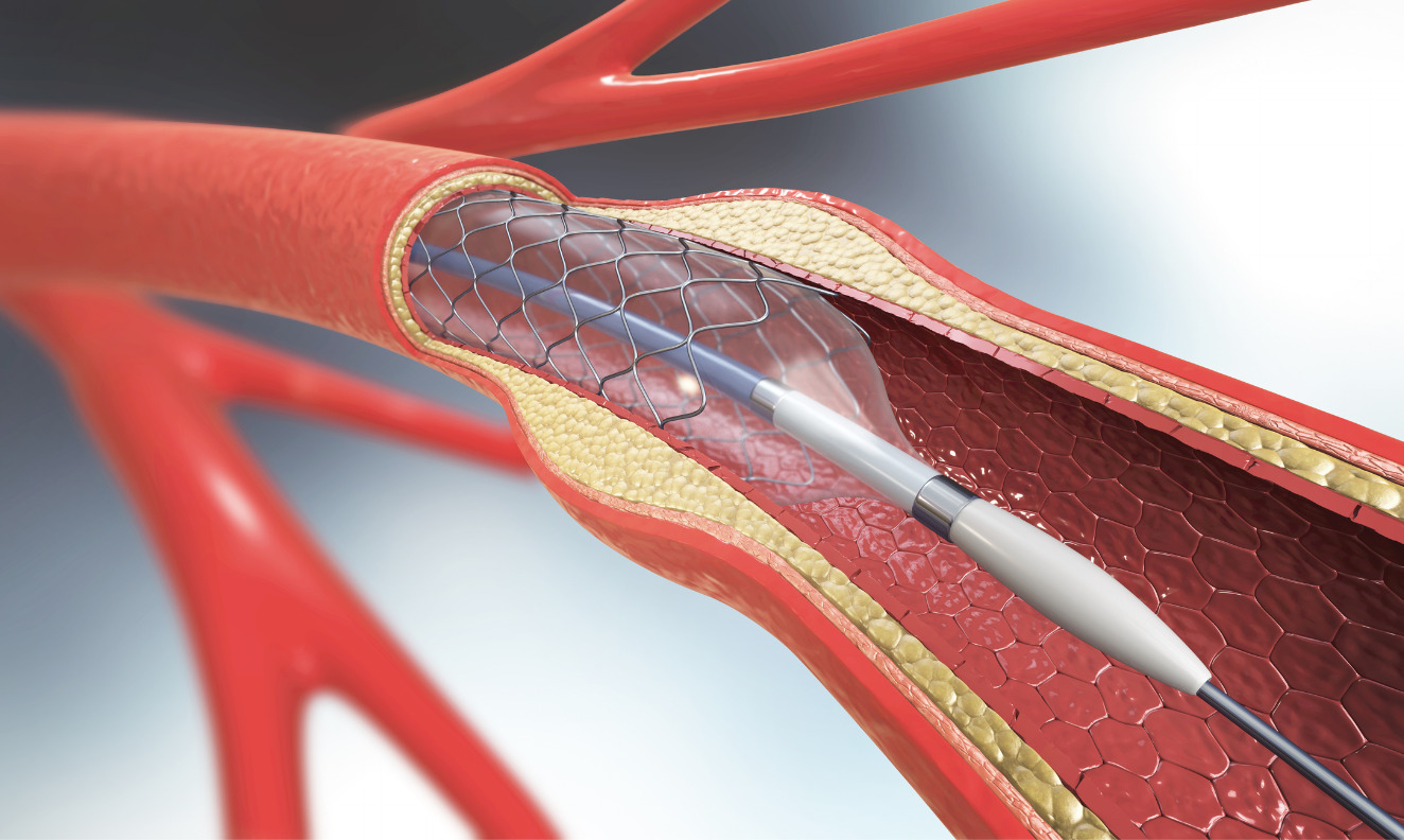 stent implantation