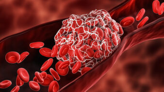 blood clot