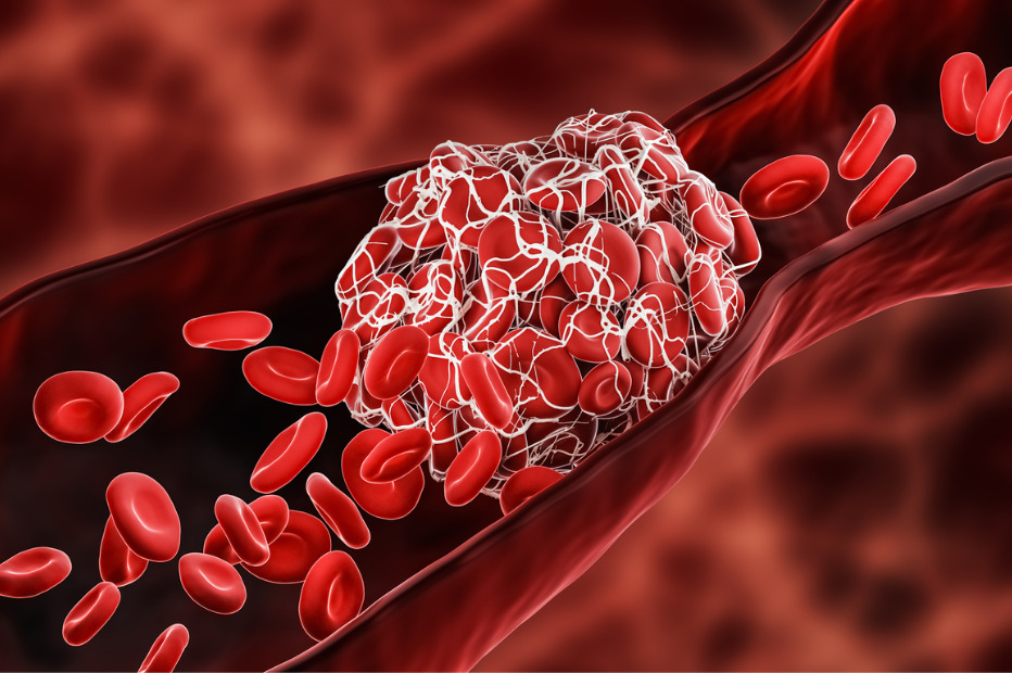 blood clot